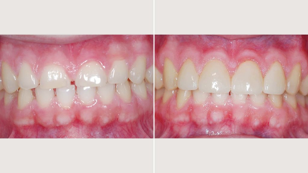 جراحی افزایش طول تاج